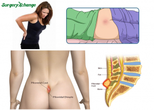 Pinodial Sinus Cyst Surgery in Bangalore