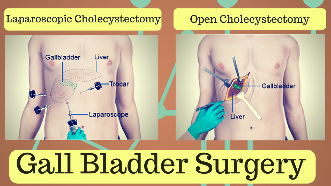 Gall Bladder Surgery In Bangalore
