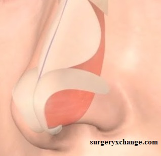 Septoplasty through surgeryxchange
