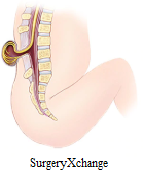 Spina bifida through SurgeryXchange