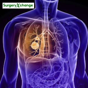 Lung cancer treatment through surgeryxchange