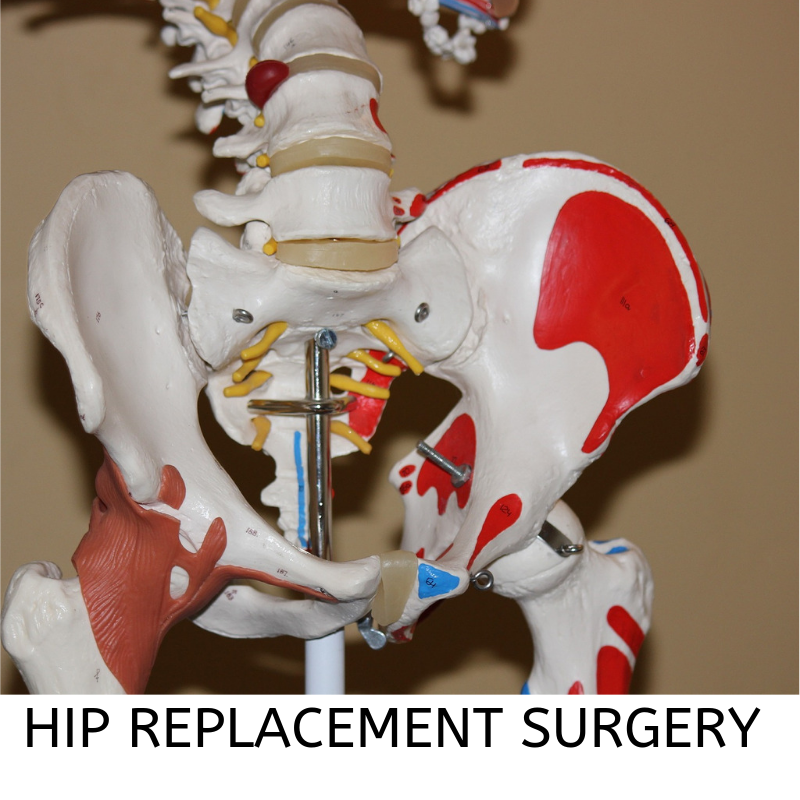 Hip replacement surgery through SurgeryXchange